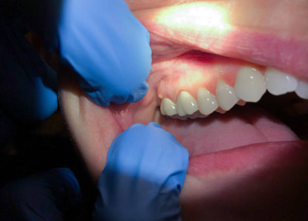 Best Chipped Tooth Repair Near Me  in Tool, TX